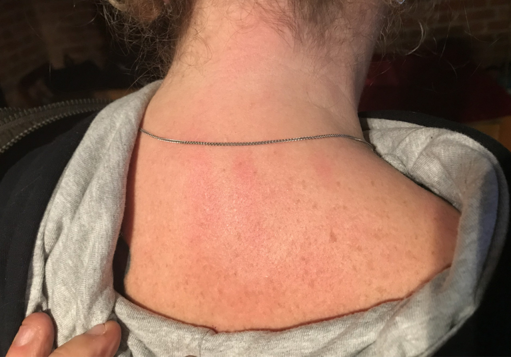 A photo of a guest who had a handprinr appear on their back.